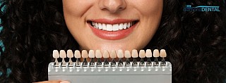 How to Care for Your Veneers After Treatment