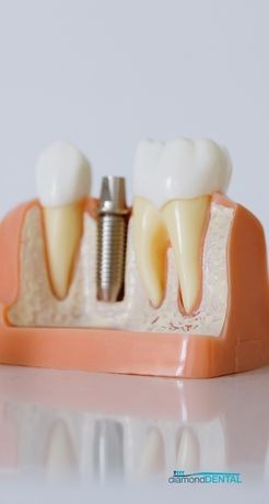 Why Dental Implants Are Worth the Investment