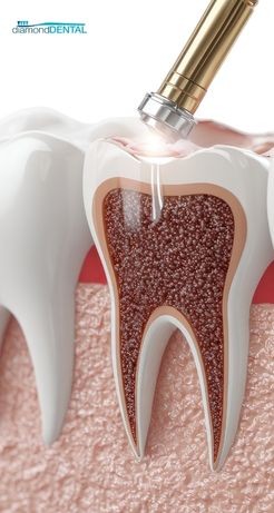 root canal treatment dentist