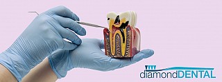 root canal dentist vaughan