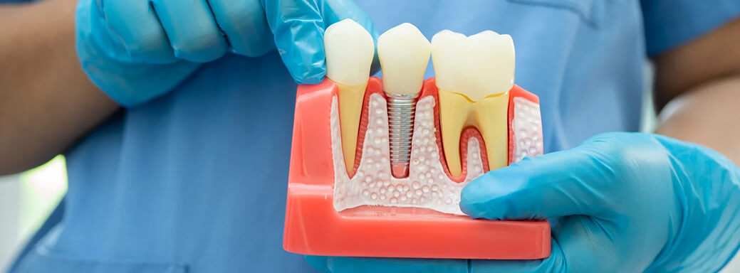 Why Dental Implants Are the Ultimate Solution