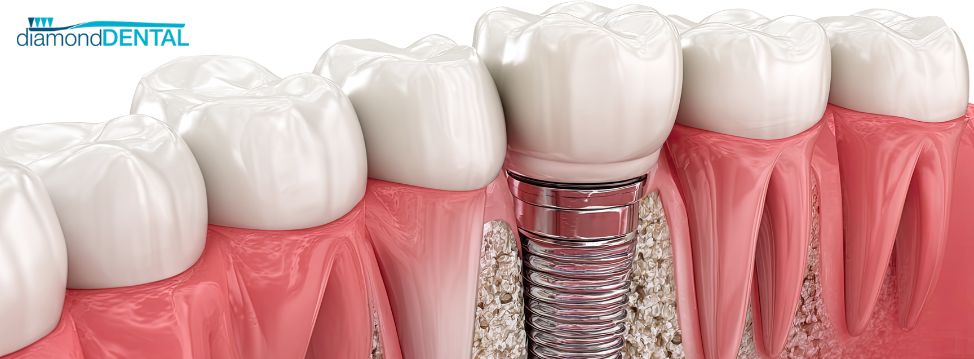 dental implants whitby