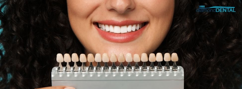 veneers dentist whitby